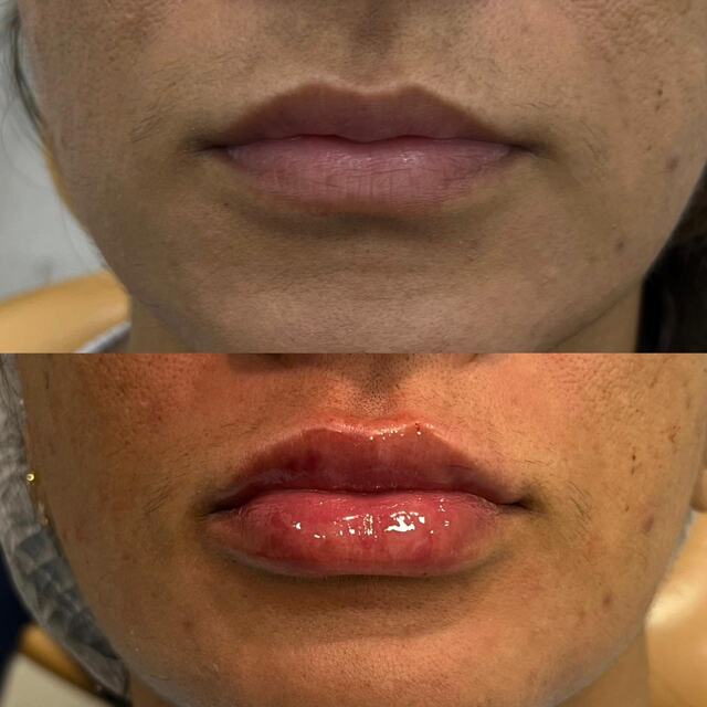 Caso clínico 01 de paciente da Armonya. Registro de antes e depois de tratamento odontológico.