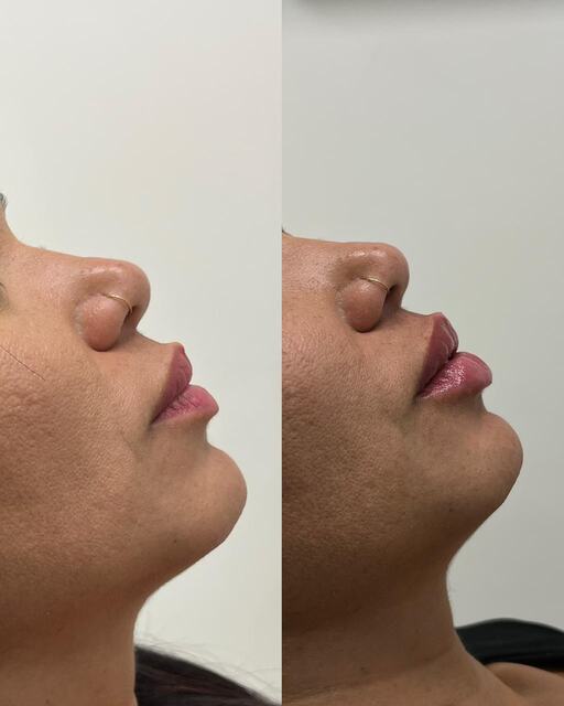 Caso clínico 02 de paciente da Armonya. Registro de antes e depois de tratamento odontológico.