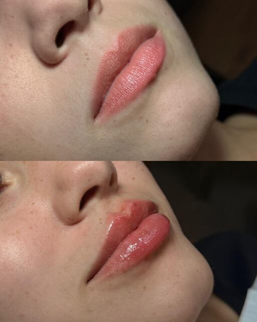Caso clínico 04 de paciente da Armonya. Registro de antes e depois de tratamento odontológico.