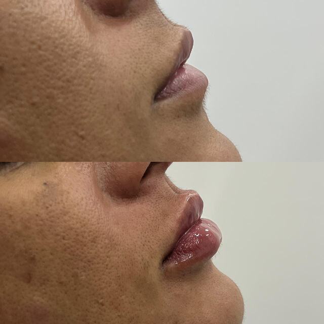 Caso clínico 05 de paciente da Armonya. Registro de antes e depois de tratamento odontológico.