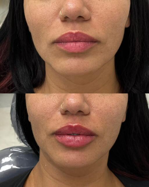 Caso clínico 06 de paciente da Armonya. Registro de antes e depois de tratamento odontológico.