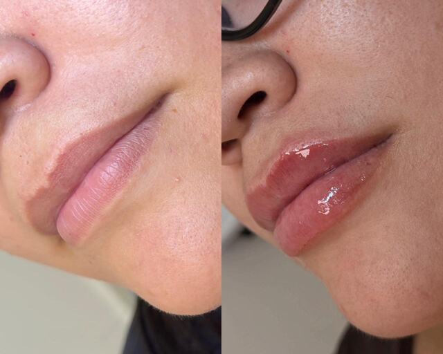 Caso clínico 07 de paciente da Armonya. Registro de antes e depois de tratamento odontológico.