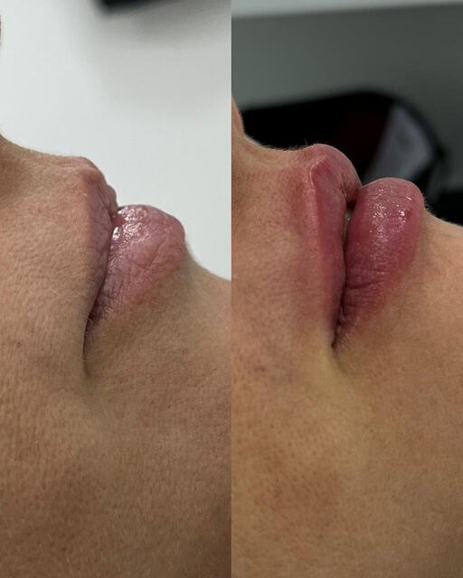 Caso clínico 08 de paciente da Armonya. Registro de antes e depois de tratamento odontológico.