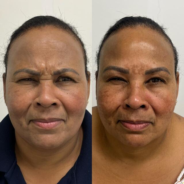 Caso clínico 10 de paciente da Armonya. Registro de antes e depois de tratamento odontológico.