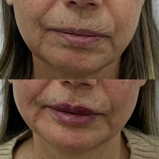 Caso clínico 11 de paciente da Armonya. Registro de antes e depois de tratamento odontológico.